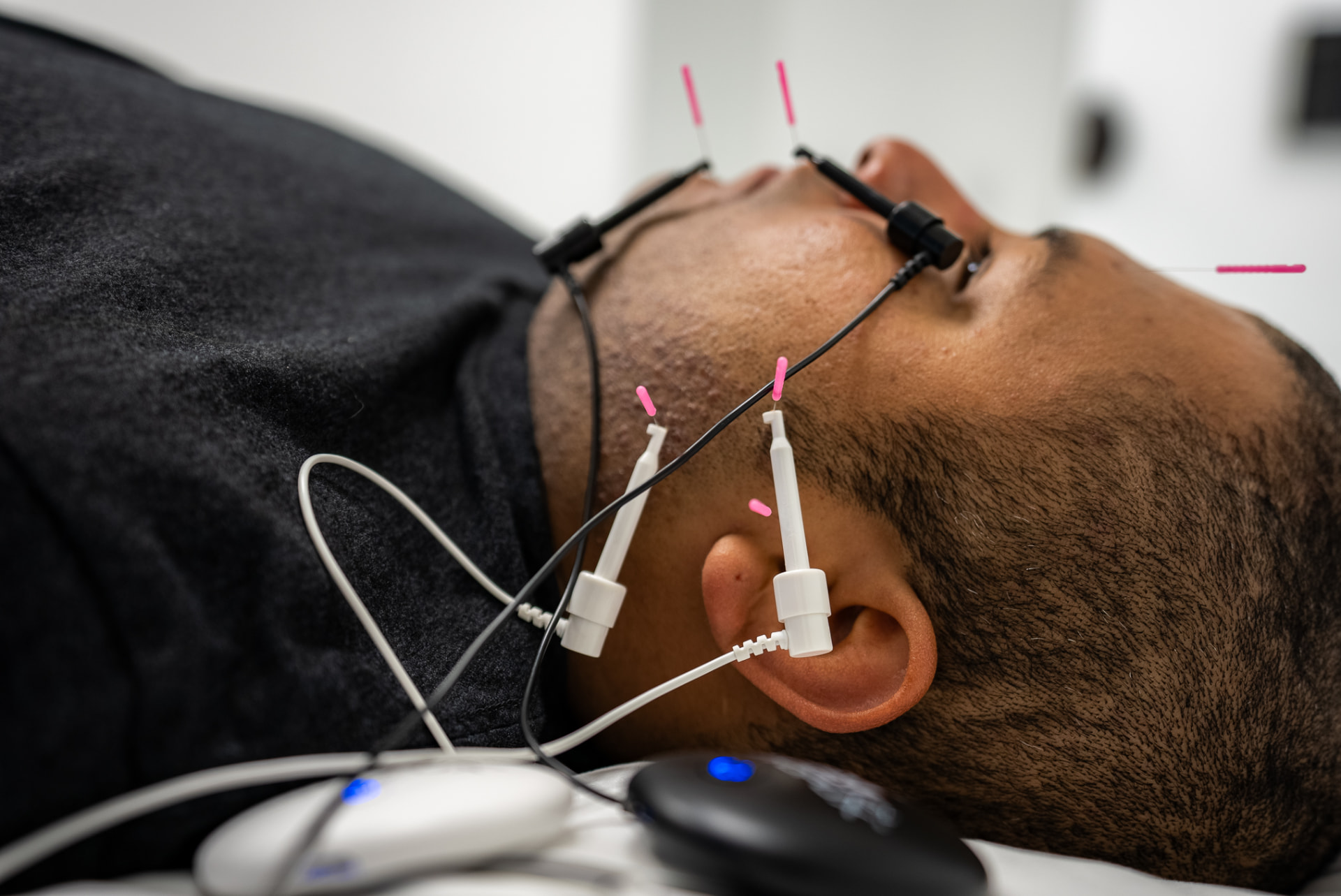 Dry needling treatment applied to a patient's jaw and neck